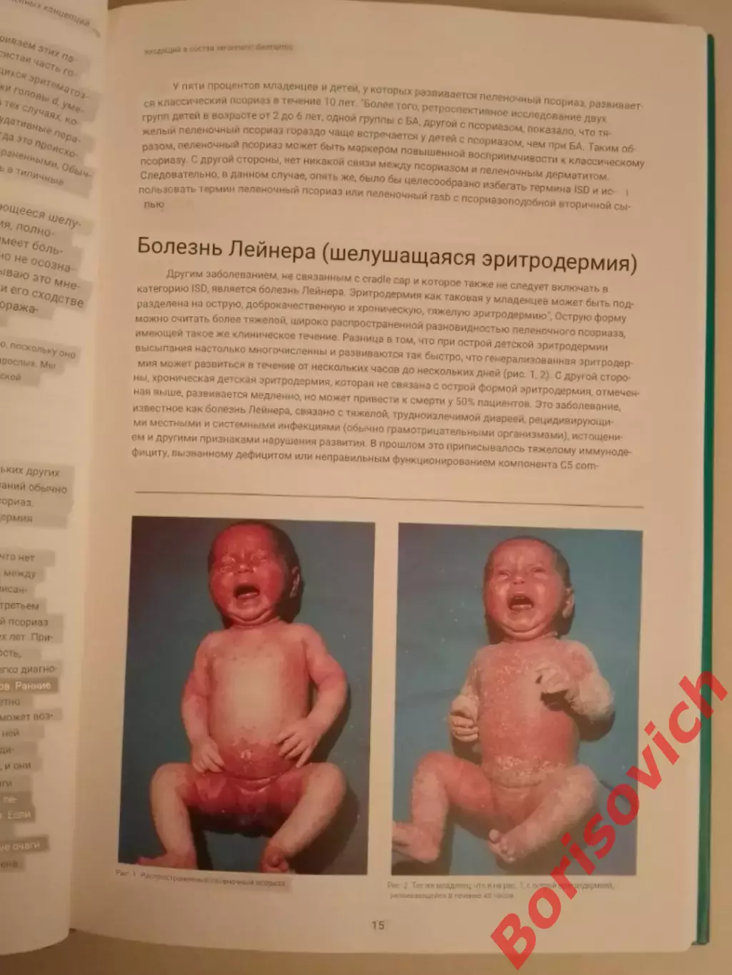 РЕДКОСТЬ! ДЕТСКАЯ ДЕРМАТОЛОГИЯ:ПРОТИВОРЕЧИЯ В СОВРЕМЕННЫХ КОНЦЕПЦИЯХ 1994 США 6