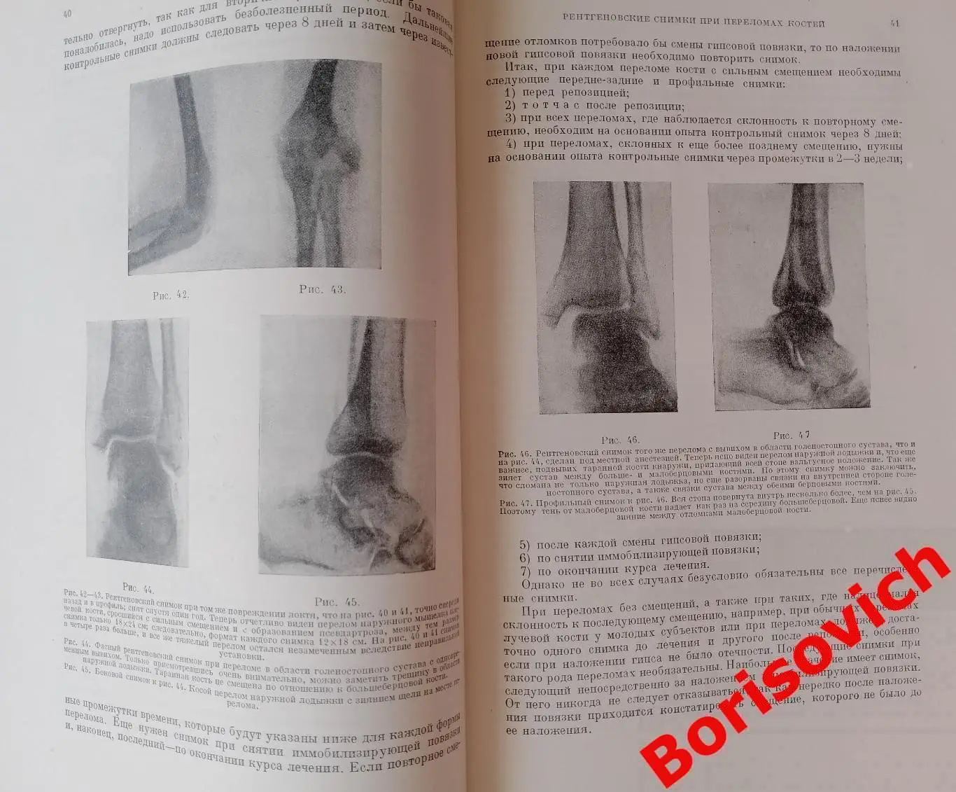 Л. Белер ТЕХНИКА ЛЕЧЕНИЯ ПЕРЕЛОМОВ КОСТЕЙ 1937 г 502 стр Тираж 10 200 экз 7