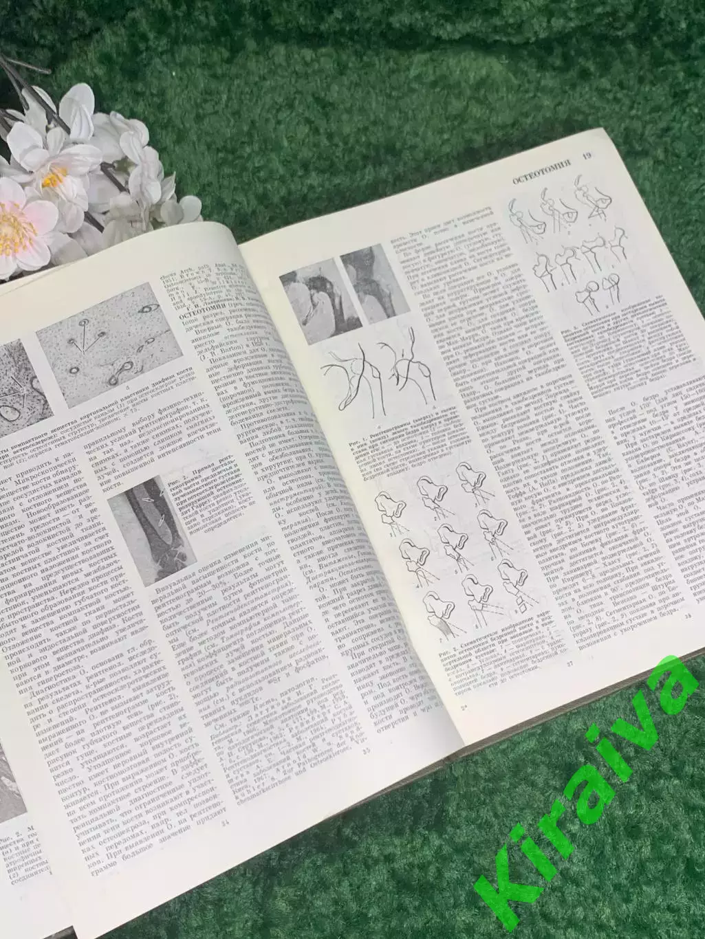 Книга том 18 «Большая медицинская энциклопедия» Остеопатия Переломы 1982 г Н2369 4