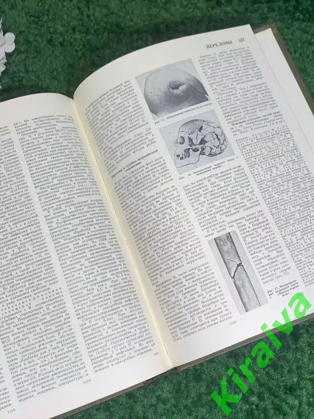 Книга том 18 «Большая медицинская энциклопедия» Остеопатия Переломы 1982 г Н2369 5